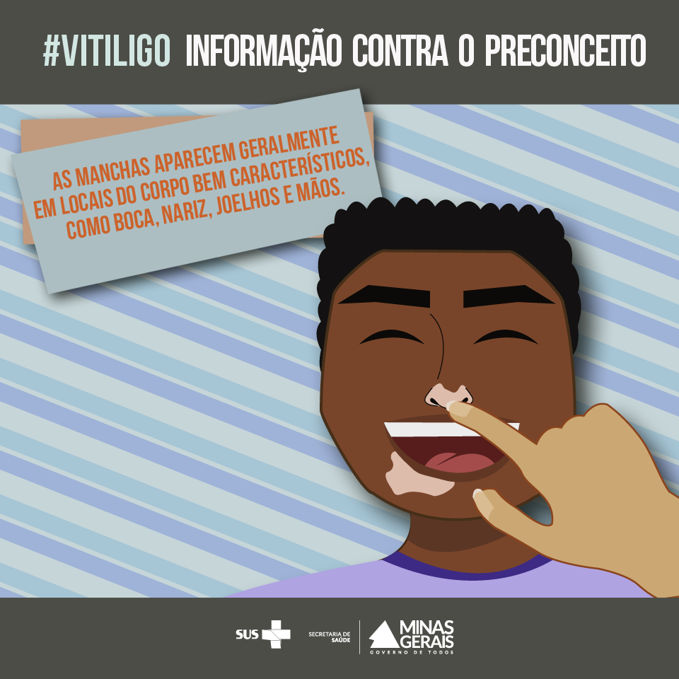 vitiligo 3