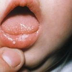 Candidíase oral ou Sapinho - Divulgação mamaepratica
